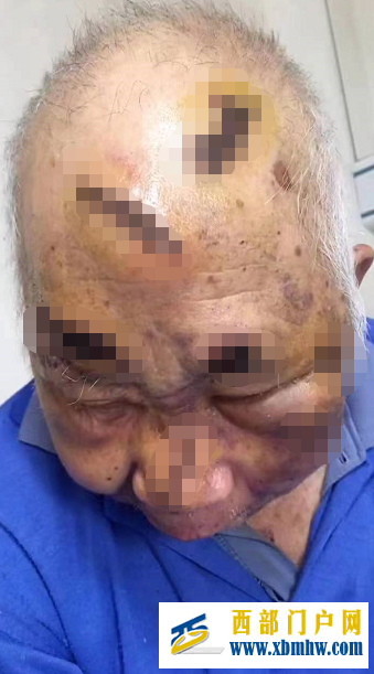 宜宾79岁老人养老院内被打？回应：与另一老人在医院起纷争受伤(图1)